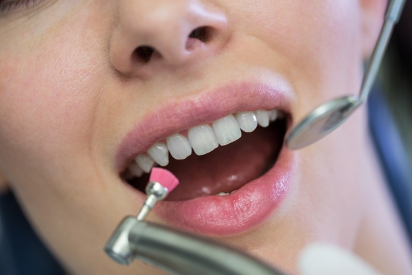 A Diferença Crucial entre Raspagem e Limpeza Dental: Entendendo a Distinção