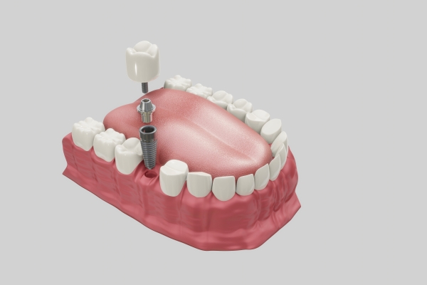 5 motivos para você ter implantes dentários