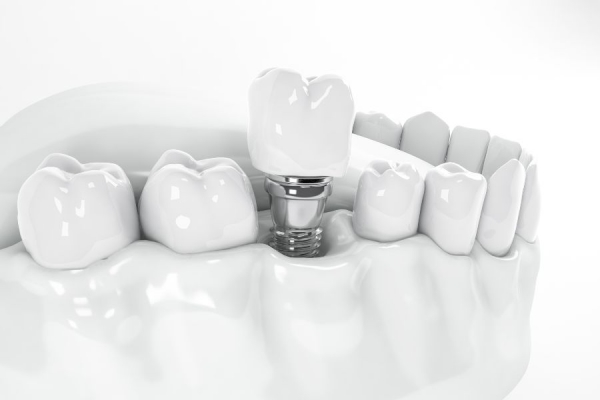 Os benefícios dos implantes dentários